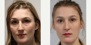 Daniel Ezra, MD, FRCS, Oculoplastic Surgeon, Specialist Registered in  Ophthalmology