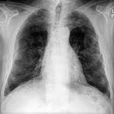 mesothelioma is an aggressive cancer that originates in the mesothelium or protective lining of cells around internal organs. Pleural Plaque Radiology Reference Article Radiopaedia Org