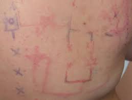Patch Tests Dermnet Nz
