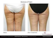 Image result for how soon before results of venus treatment before and after