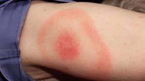 Diagnosis can be even more complicated if you do not remember being bitten by a tick. Lyme Disease Can Be Diagnosed By Bull S Eye Rash Alone Bbc News