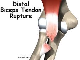 These are some faqs about bicep tendon pathology as answered by the doctors at complete orthopedics, on long island ny. What Is A Biceps Tendon Rupture And How Is It Fixed Beacon Orthopaedics Sports Medicine