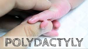 · pinky finger traits and corresponding little finger ring meaning one or more of the following points may apply to someone who wears a ring on their little finger: Baby With Six Fingers In Left Hand Polydactyly Postaxialpolydactyly Youtube