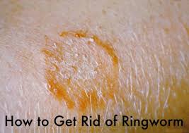 Use this solution to scrub the pet carriers, kennels, toys and similar items of infected pets. How I Got Rid Of Ringworm Patient S Lounge