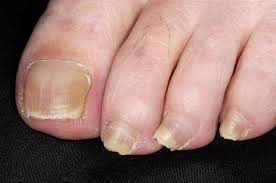 Image result for mykoza nehtů