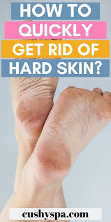 Feet with dead skin do not look good and can lead to bigger problems in the long run. How To Get Rid Of Dead Skin On Feet Step By Step Guide Dead Skin On Feet Hard Skin On Feet Dry Skin On Feet