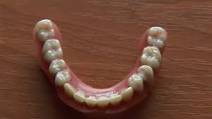 Zahnprothesen Ungarn Kunststoffprothesen Ungarn Vollprothesen Ungarn Teilprothesen Mit Geschiebe Geschiebeprothese Vollprothese Mit Goldnetz Vollprothese Mit Metallbasis Metallprothese Metallplatte Prothesenreparatur Provisorische Prothese