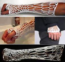3d Printed Cast Lets Broken Arms Breathe Odor Free Broken Bone Prints Broken Arm
