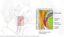Image result for what treatment are available for tumors in throat
