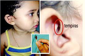 Sakit telinga dapat disebabkan oleh berbagai gangguan kesehatan, salah satunya yaitu infeksi telinga. Anak Mengadu Sakit Di Telinga Ibu Terkejut Jumpa Sarang Tempiras Dalam Telinga Anak Sampai Sudah Bertelur