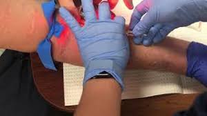 Vein mapper device can digitally project the image of the veins on the surface of patient's skin in real time, which can help healthcare professionals to verify the vein directly. Clinically Proven Vein Finders For Iv Access