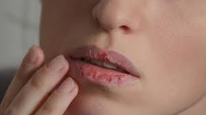 Sie sitzen überwiegend im mundwinkel oder unmittelbar am rand der lippe. Trockene Lippen Tipps Fur Mehr Feuchtigkeit Stern De
