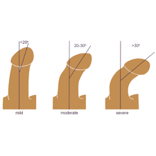 Image result for Chordee