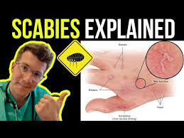 Image result for scabies symptoms