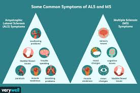 Amyotroph lateral scleros other motor neuron disord. Als And Multiple Sclerosis Similarities And Differences