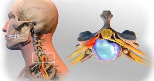 Pin On Spinal Woes