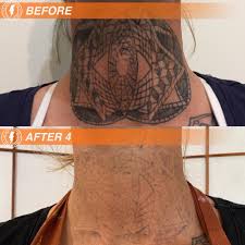 Melbourne tattoo removal, caulfield north, victoria. The Tattoo Removal Co Laser Tattoo Removal Adelaide