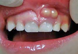 Tooth Abscess: How To Identify, Treat, And Prevent - Fresno Dentist |  General Dentistry | Dr Guillermo Donan Dds