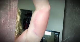 Florida Man Contracts Flesh Eating Bacteria Without Even Touching Water Wdef