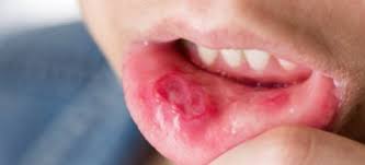 Infected Lip Piercing Diagnosis Home Treatment