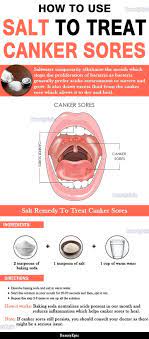 How To Use Salt To Treat Canker Sores Canker Sore Canker Sore Remedy Cankers