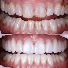 Risks and considerations when using crowns for protrusion