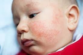 Baby 9 months with eczema. Eczema Or Infant Acne How To Tell The Difference