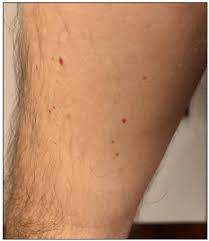 Maybe you would like to learn more about one of these? Scielo Brasil A Case Of Covid 19 With Papulovesicular Rash That Progressed To Retiform Purpura Accompanied By Cherry Angiomas A Case Of Covid 19 With Papulovesicular Rash That Progressed To Retiform Purpura