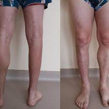 Leg muscles diagram labeled : 2015 Hypotrophy Of The Only Right Leg Muscles Most Prominent In Download Scientific Diagram