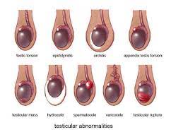 You might notice it randomly, like when you're. Signs And Symptoms Of Testicular Cancer Ultrasound Dimensions Dublin