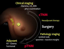 The higher the levels, the faster the cells are dividing and. The Radiology Assistant Staging And Treatment Of Breast Cancer