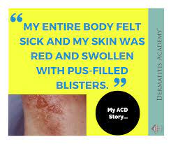 Propylene Glycol Struggle My Allergic Contact Dermatitis Story Dermatitis Academy