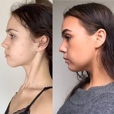 18 Months Of Mewing Weightloss Mewing Works Mewing