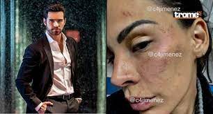 Son las lesiones que le provocó el actor eleazar gómez, según un médico. Stephanie Valenzuela Shows A Disfigured Face After Reporting Eleazar Gomez S Beating Photos Mexico Physical Violence Femicide Cdmx City Attorney General S Office Boconvip Archyde