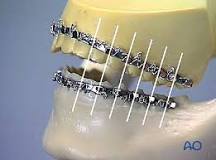 Image result for what is an arch bar regarding tmj treatment?