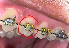 Braces are a tool used to properly position teeth in your mouth. Elastic Band On Bracket Is Loose On The Bottom Left Corner But Secure On The Remaining 3 Corners It Doesn T Irritate Me And The Wire Is Still Secured In The Bracket My
