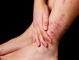 Culebrilla de ruth m beltran, que 623 personas siguen en pinterest. Culebrilla Conozca La Enfermedad Del Mito