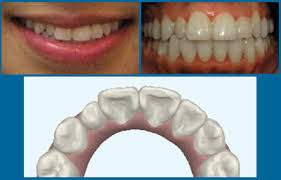 The Size And Shape Of Your Teeth Manhattan Bridge Orthodontics