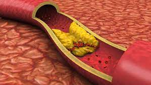Move out, cholesterol | Vanderbilt University