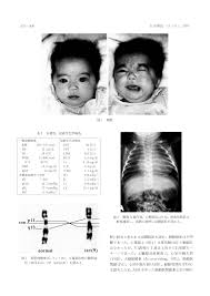 Cardiofacial syndromeの一卵性双胎例