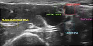Image result for Axillary Nerve Block