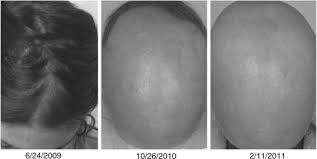 Primary gh resistance is characterized by thin hair, while acromegaly may cause hypertrichosis. Growth Hormone Deficiency In A Young Patient With Alopecia Areata Sciencedirect