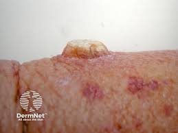 Image result for cornu cutaneum)