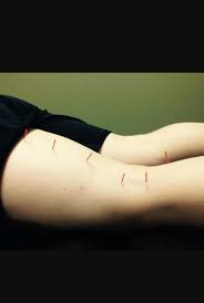 In human anatomy, a hamstring (/ˈhæmstrɪŋ/) is any one of the three posterior thigh muscles in between the hip and the knee (from medial to lateral: Stephen Flynn Physio On Twitter Dry Needling For Hamstring Injury Excellent Results In The Release Of Tension And Tightness In Muscles Treatment Available In Clinic Https T Co Dxtjlnhsam