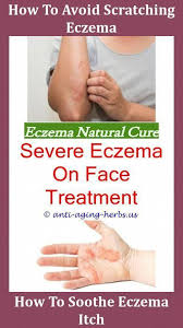 How Can I Treat Eczema Best Shower Oil For Eczema Bad Case Of Eczema Fungal Eczema On Face Is Eczema A Rash Raw Shea How To Treat Eczema Oils For Eczema Eczema