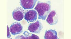 Bone marrow transplant, the transfer of bone marrow from a healthy donor to a recipient whose own bone marrow is affected by disease. Genetically Engineered Bone Marrow Cells Slow Growth Of Prostate And Pancreatic Cancer Cells In Mice
