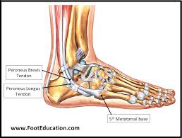 Flexor tendon injuries account for less than 1%. Flexor Hallucis Longus Tendon Transfer To The Peroneus Brevis Footeducation