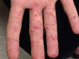 Hand, foot, and mouth, also called coxsackie virus, is an infection caused by the enterovirus. Hand Foot And Mouth Disease Consultant360