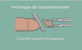 Il est essentiel à son développement tant physique que psychique, comme à son éveil. Circoncision Comment Ca Se Passe Video Integrale Lmdm