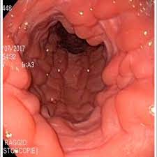 Endoscopic view of the right uterine body and horn. No bifurcation is... |  Download Scientific Diagram